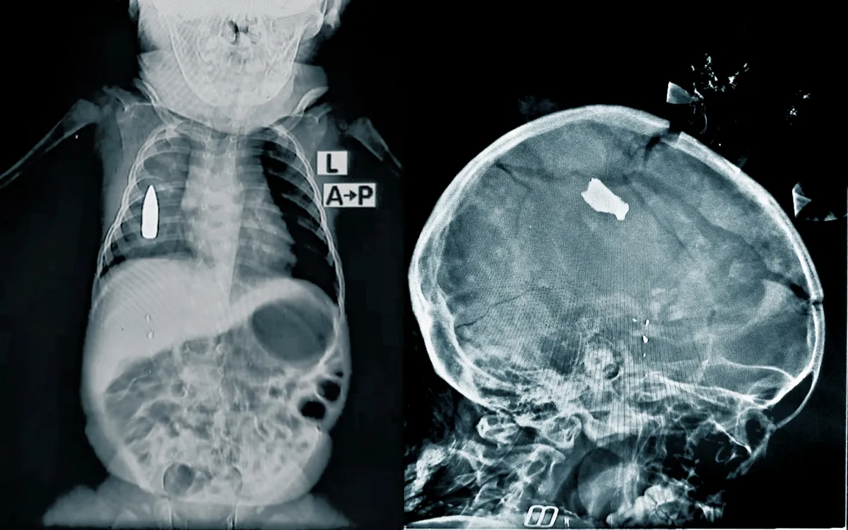 Röntgenbilder verletzte Kinder