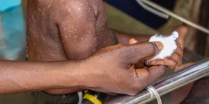 Epidémie de rougeole à Kampene