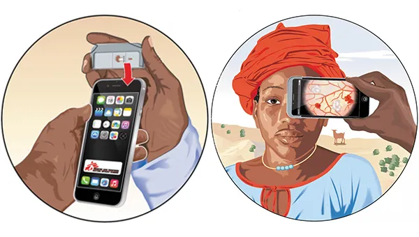 Smartphones, die Leben retten: Malaria-Diagnose für Kinder