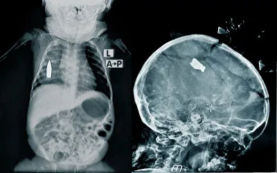 Röntgenbilder verletzter Kinder