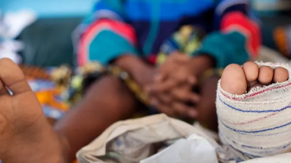 Tropenkrankheit Buruli Ulkus