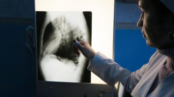 Eine Krankenschwester betrachtet die Röntgenbilder eines von Ärzte ohne Grenzen betreuten Tuberkulose-Patienten.